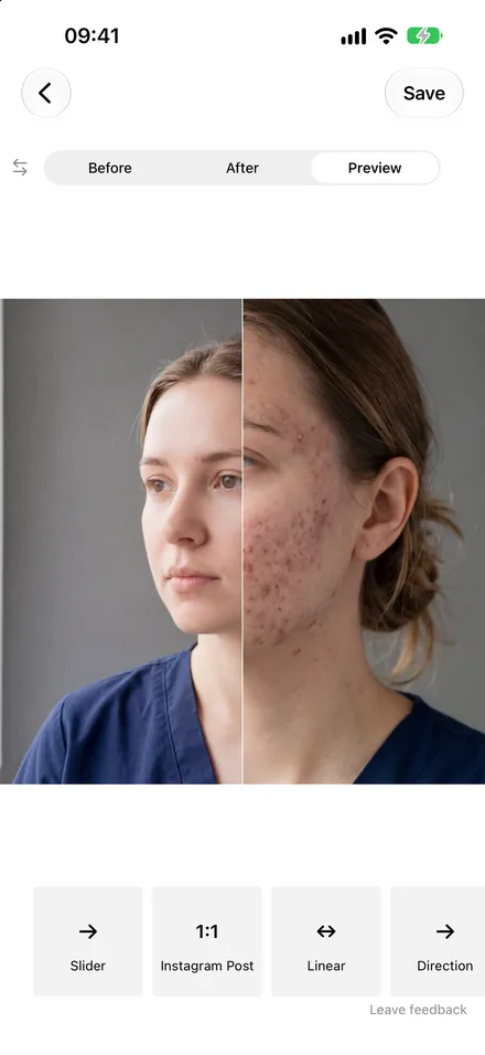 A finished slider video of acne treatment, ready to save